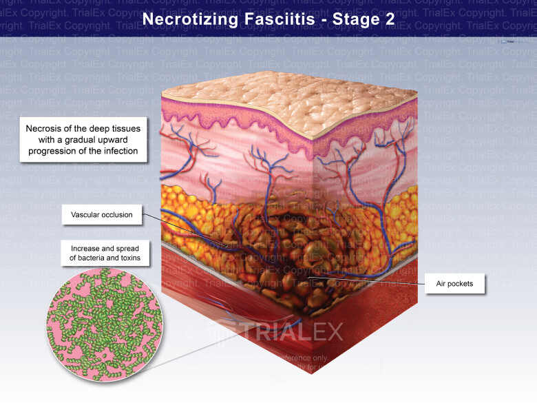 Necrotizing Fasciitis Stage 2 Necrotizing Fasciitis Stage 2