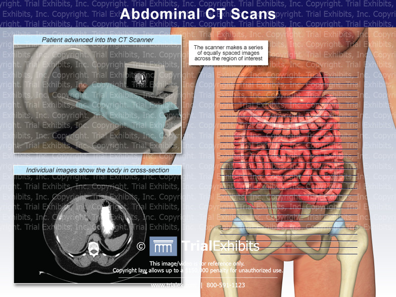 Abdominal CT Scans TrialQuest Inc Abdominal CT Scans TrialQuest Inc