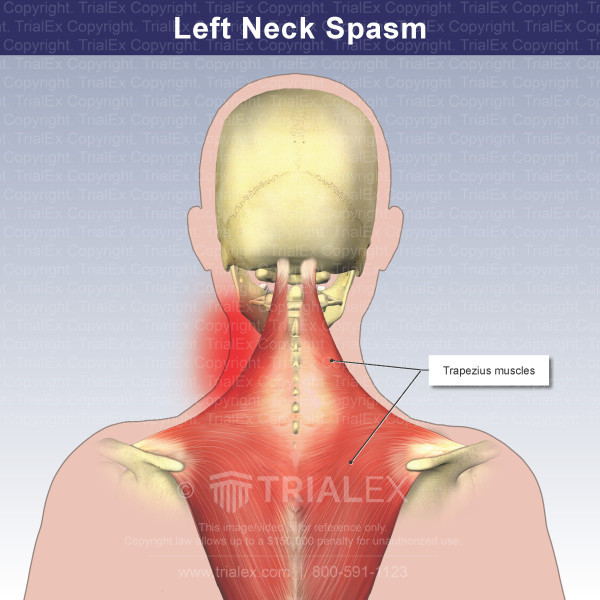 Left Neck Spasm Trial Exhibits Inc 