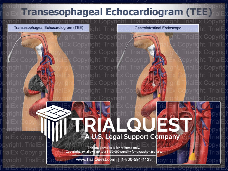 Transesophageal Echocardiogram Transesophageal Echocardiogram
