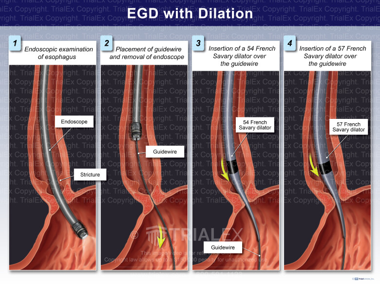 EGD With Dilation TrialQuest Inc 
