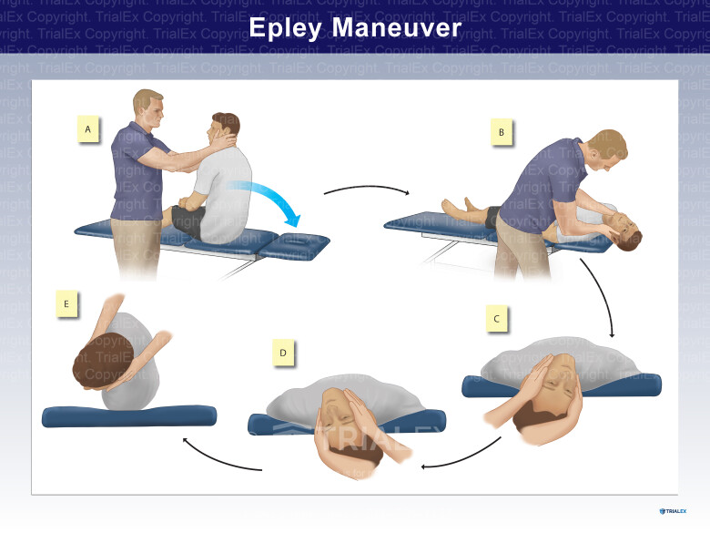 Epley Maneuver Epley Maneuver