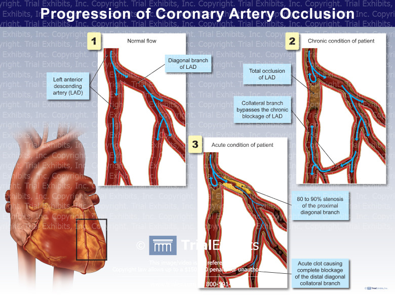 Progression Of Coronary Artery Occlusion TrialQuest Inc 