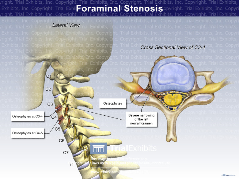 Foraminal Stenosis Trial Exhibits 55 OFF