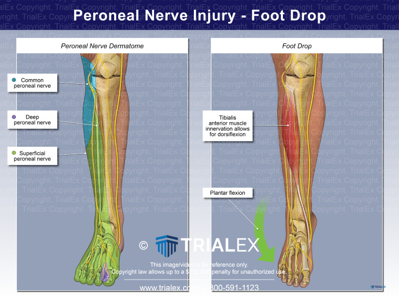 Peroneal Nerve Injury Foot Drop Peroneal Nerve Injury Foot Drop