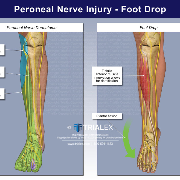 Medical Legal Exhibits Legal Animations Trial Graphics Tria 