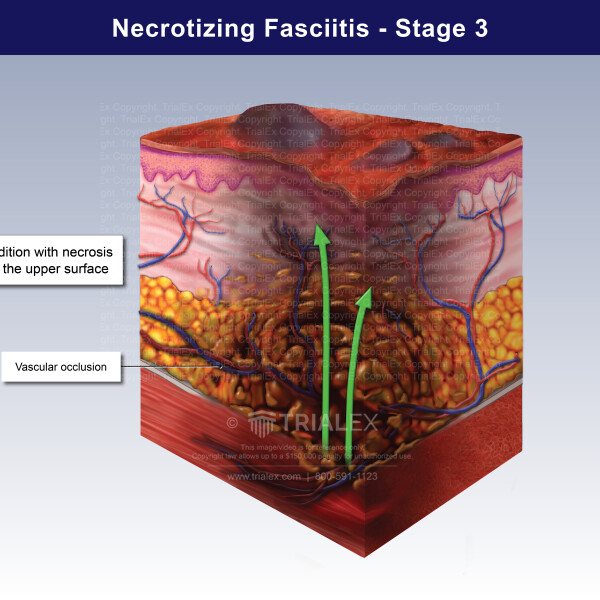 Progress Of Necrotizing Fasciitis