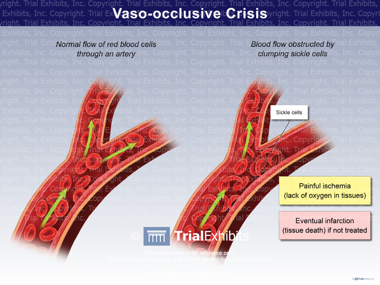 Vaso occlusive Crisis TrialQuest Inc 