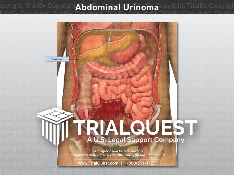 Abdominal Urinoma