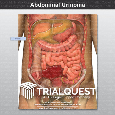 Abdominal Urinoma