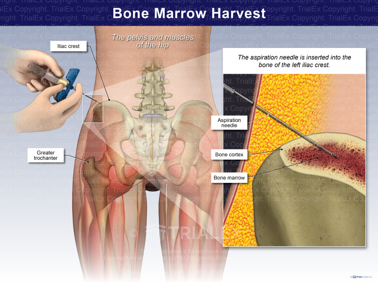 Bone Marrow Harvest TrialQuest Inc 
