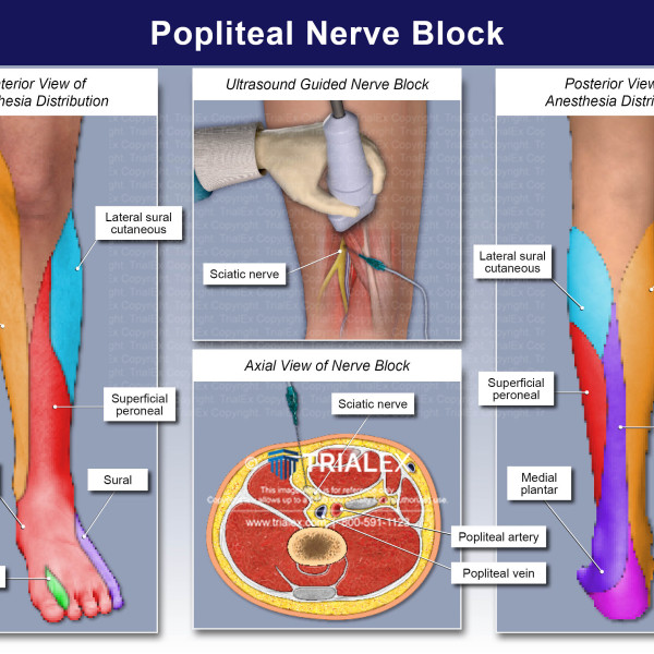 Popliteal Block