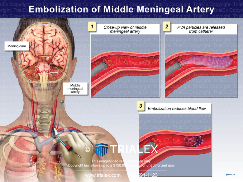 Embolization Of Middle Meningeal Artery