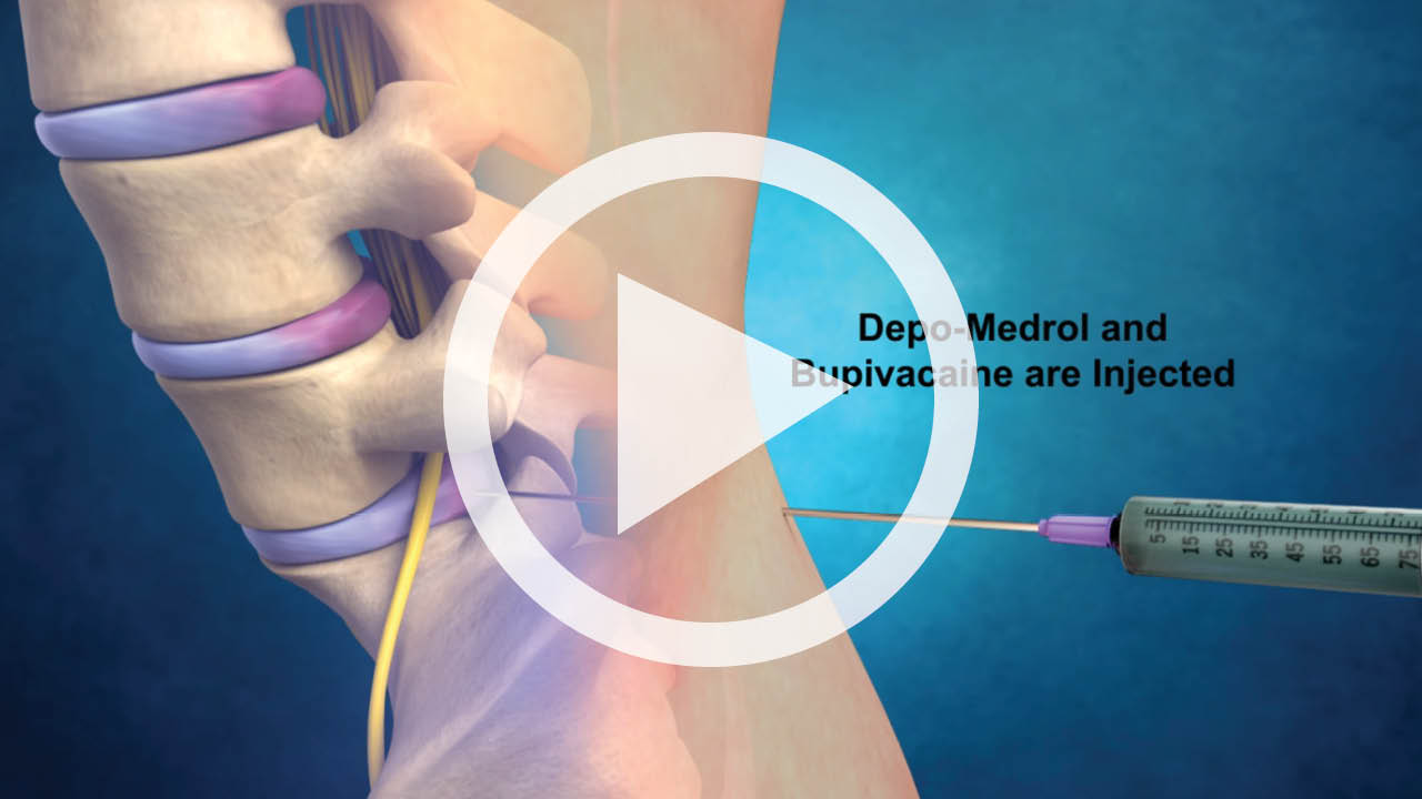 Steroid Injection L5 S1