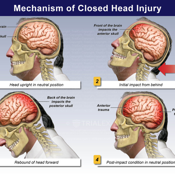 Medical Legal Exhibits Legal Animations Trial Graphics Tria 
