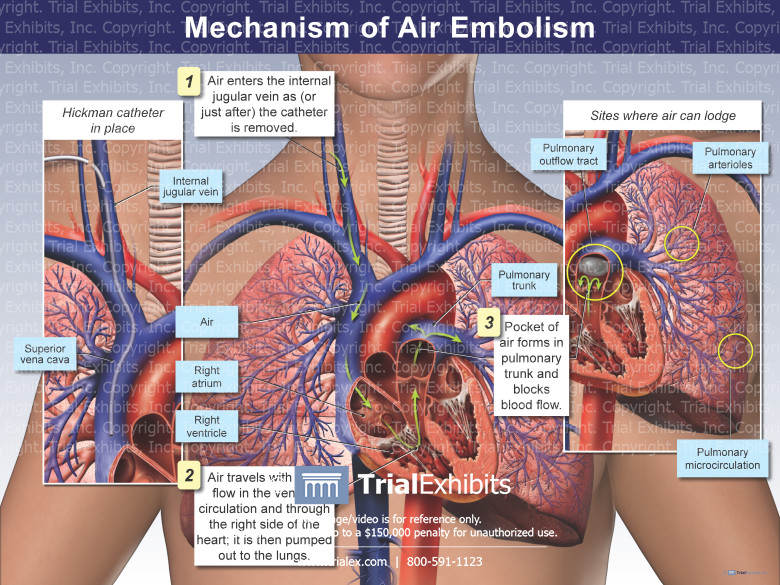 Mechanism Of Air Embolism TrialQuest Inc 
