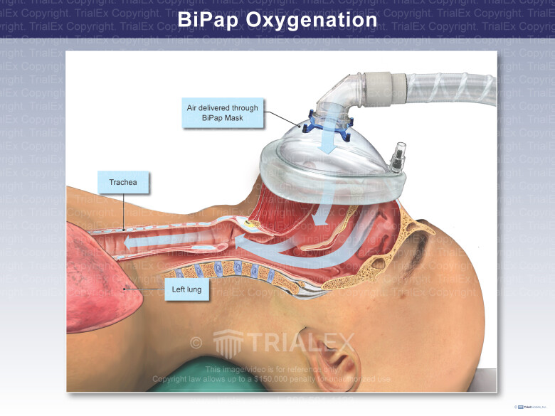 BiPap Oxygenation BiPap Oxygenation
