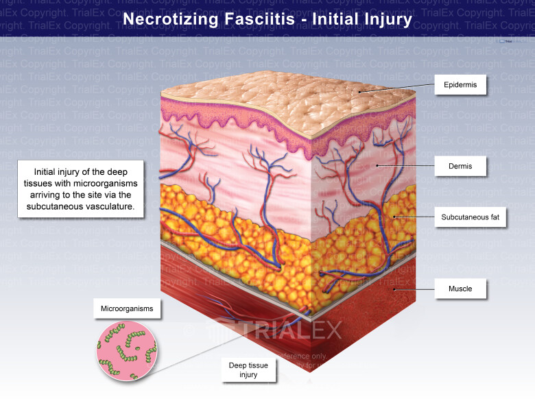 Necrotizing Fasciitis Initial Injury TrialQuest Inc Necrotizing Fasciitis Initial Injury TrialQuest Inc