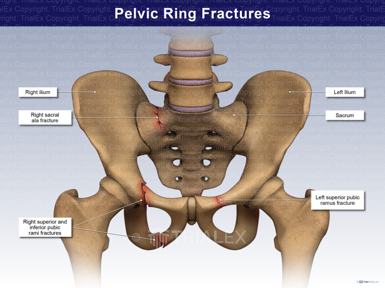 Pubic Ramus