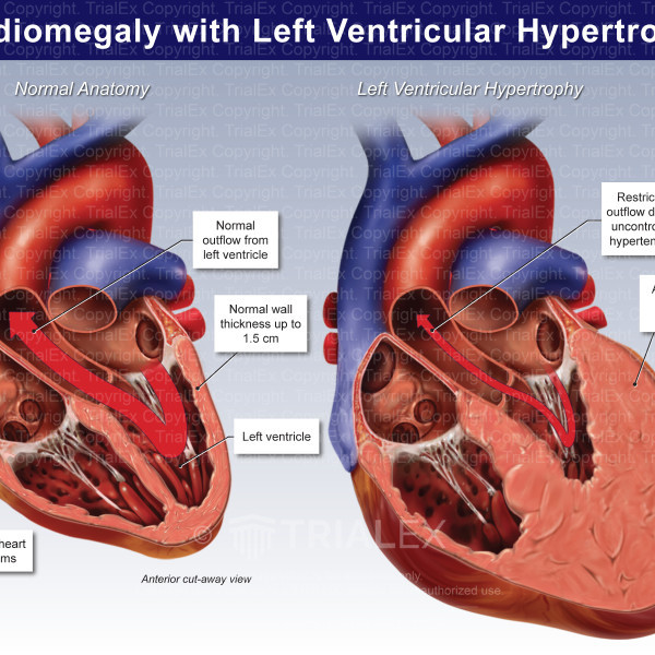 Cardiomegaly Diagram