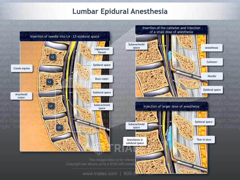 Lumbar Epidural Anesthesia Lumbar Epidural Anesthesia