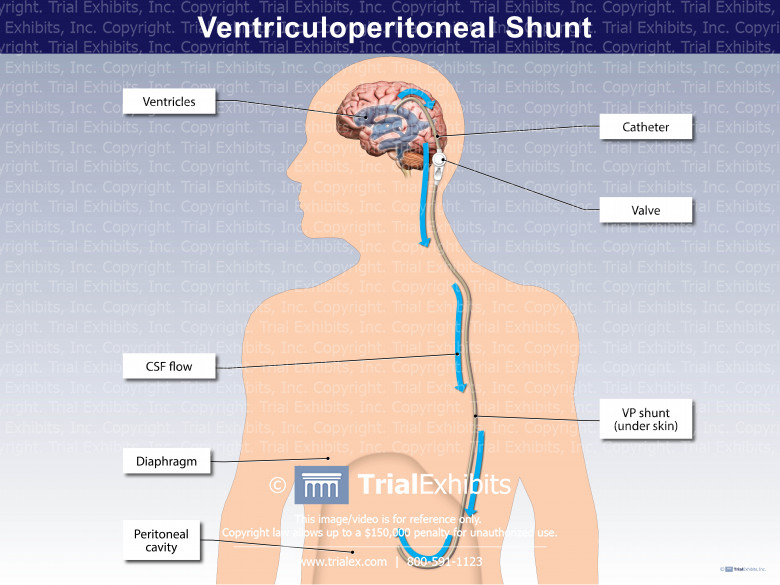 Ventriculoperitoneal Shunt Ventriculoperitoneal Shunt