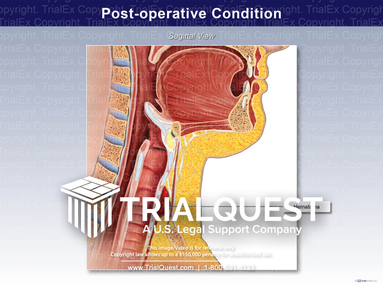 Post-Operative Condition
