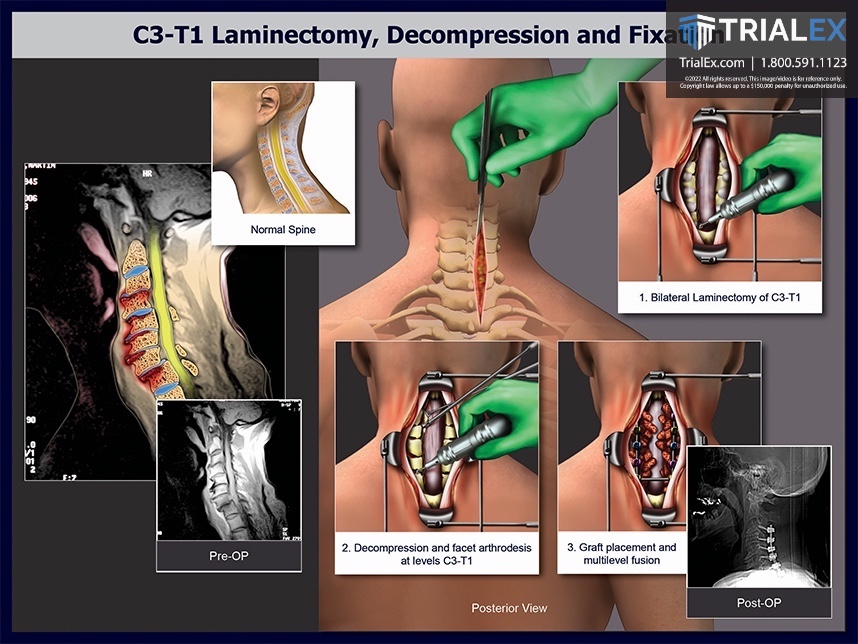 C3-T1 Laminectomy, decompression, fixation illustration of colorized film and illustrations of problem contrasted by a normal spine illustration, pre- and post-op x-rays